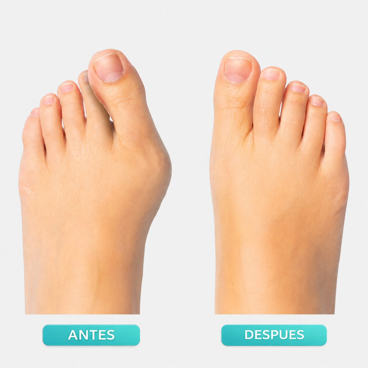 ComfortDial Bunion Corrector-FD6U