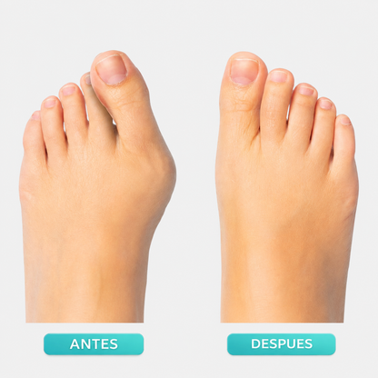 ComfortDial Bunion Corrector-FD6U