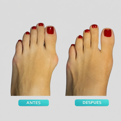 ComfortDial Bunion Corrector-FD6U